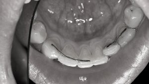 ortodonzia-invisibile-studio-medico-dentistico-ghidini-bologna-castiglionedellestiviere3