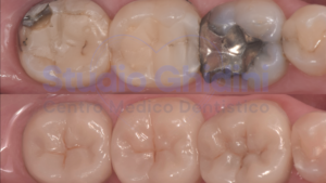 intarsi-dentali-studio-medico-ghidini-dentista-bologna-castiglione-3