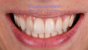 ricostruzioni-estetiche-composite-estetica-sorriso-studio-ghidini-bologna-castiglione-delle-stiviere-caso3-d