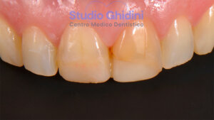 ricostruzioni-estetiche-composite-estetica-sorriso-studio-ghidini-bologna-castiglione-delle-stiviere-caso2-a