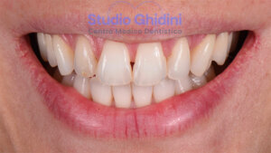 ricostruzioni-estetiche-composite-estetica-sorriso-studio-ghidini-bologna-castiglione-delle-stiviere-caso3-a