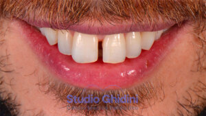 ricostruzioni-estetiche-composite-estetica-sorriso-studio-ghidini-bologna-castiglione-delle-stiviere-caso1-a