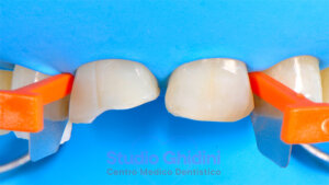 ricostruzioni-estetiche-composite-estetica-sorriso-studio-ghidini-bologna-castiglione-delle-stiviere-caso2-b