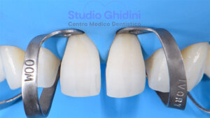 ricostruzioni-estetiche-composite-estetica-sorriso-studio-ghidini-bologna-castiglione-delle-stiviere-caso3-b