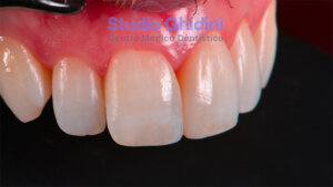 ricostruzioni-estetiche-composite-estetica-sorriso-studio-ghidini-bologna-castiglione-delle-stiviere-caso1-b