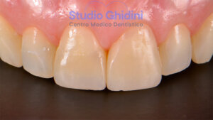 ricostruzioni-estetiche-composite-estetica-sorriso-studio-ghidini-bologna-castiglione-delle-stiviere-caso2-c