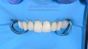 ricostruzioni-estetiche-composite-estetica-sorriso-studio-ghidini-bologna-castiglione-delle-stiviere-caso3-c