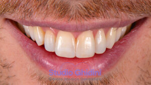 ricostruzioni-estetiche-composite-estetica-sorriso-studio-ghidini-bologna-castiglione-delle-stiviere-caso1-c